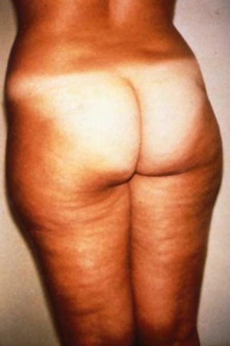 Before image 1 Case #81621 - Liposuction