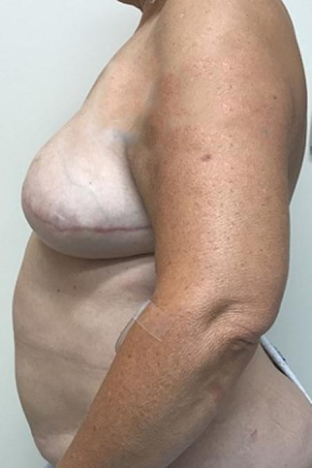 Before image 3 Case #87326 - Breast Reconstruction Revision