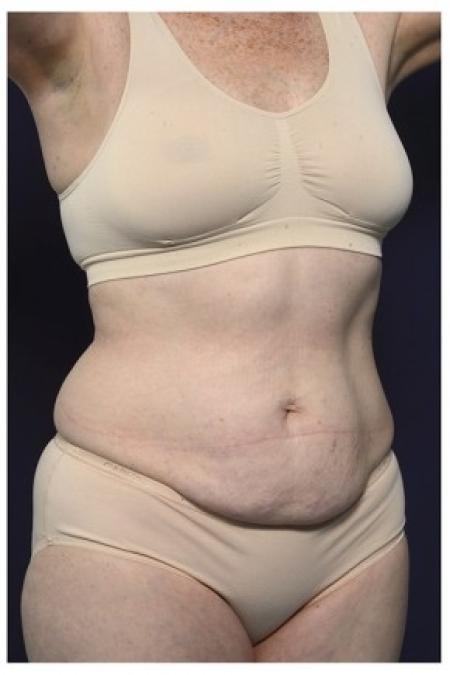 Before image 2 Case #86221 - 50 year old woman treated with an Abdominoplasty