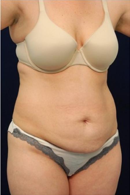 Before image 2 Case #82166 - Tummy Tuck