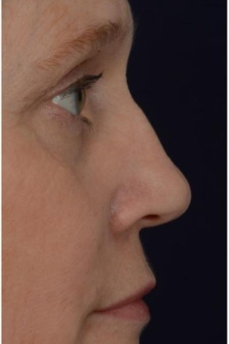 Before image 2 Case #86321 - 50 year old woman treated with nonsurgical rhinoplasty