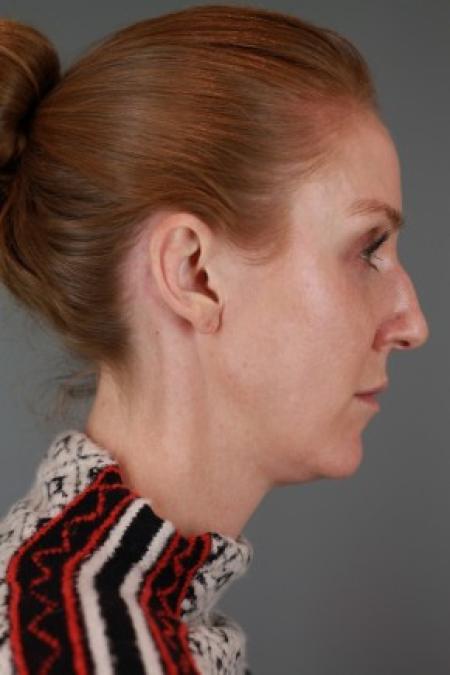 Before image 3 Case #87561 - Rhinoplasty