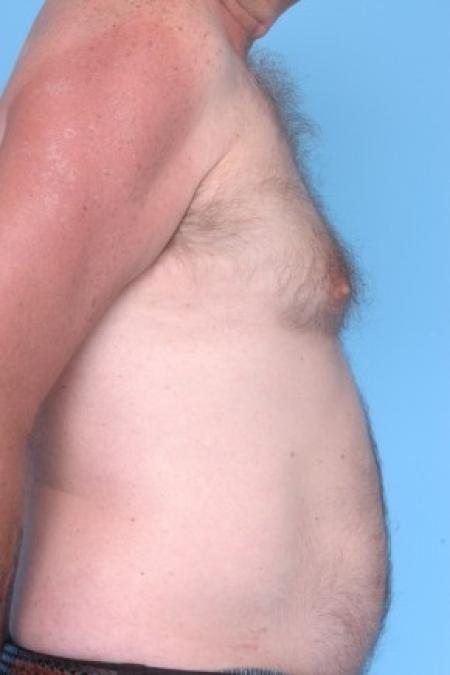 Before image 2 Case #81211 - Liposuction