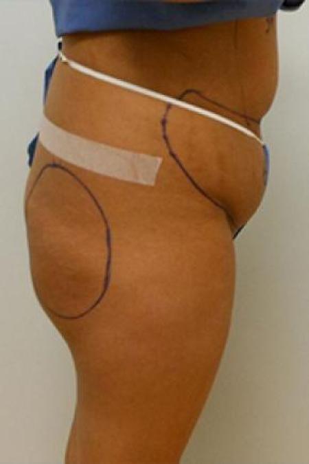 Before image 1 Case #84911 - Buttock Augmenation with implants and liposuction of the abdomen