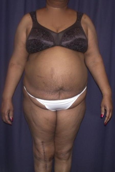 Before image 1 Case #82201 - LipoAbdominoplasty