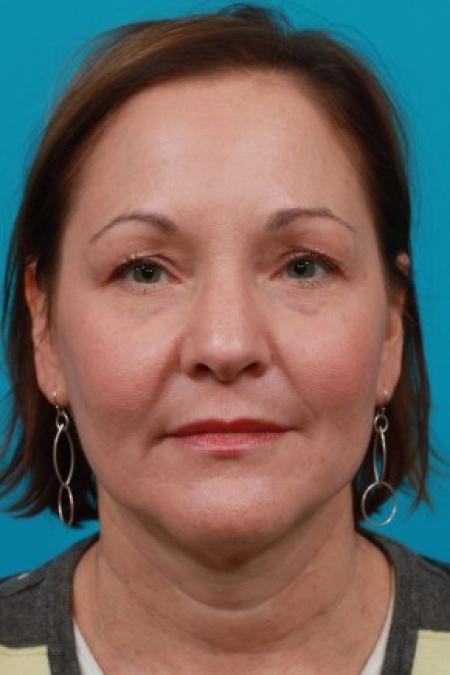 Before image 1 Case #82991 - Facial Rejuvenation
