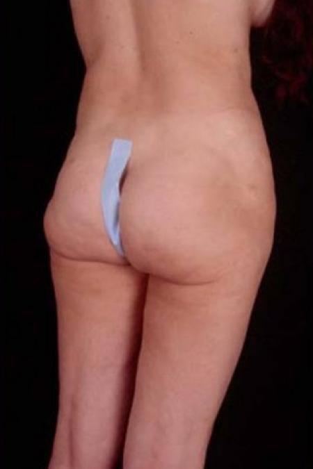 Before image 3 Case #81666 - Liposuction