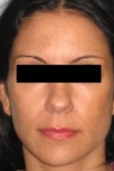 Before image 1 Case #85656 - Rhinoplasty 