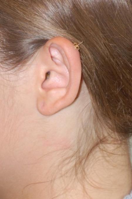 Before image 1 Case #86966 - Otoplasty (Ear Surgery)