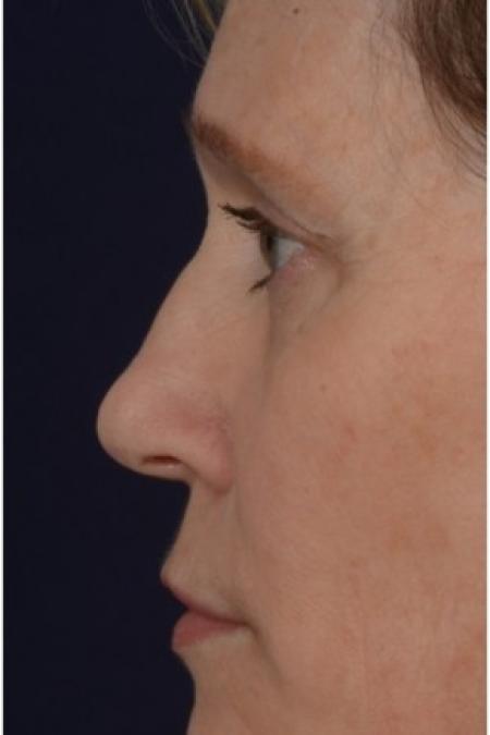 Before image 2 Case #86316 - 50 year old woman treated with nonsurgical rhinoplasty