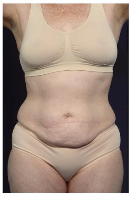 Before image 1 Case #85606 - Abdominoplasty