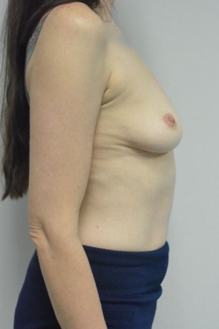 Before image 3 Case #88096 - 45-55 year woman treated with Ideal Structured Saline Implants
