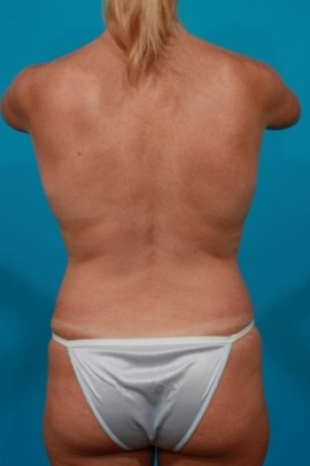 Before image 5 Case #80751 - Mommy Makeover