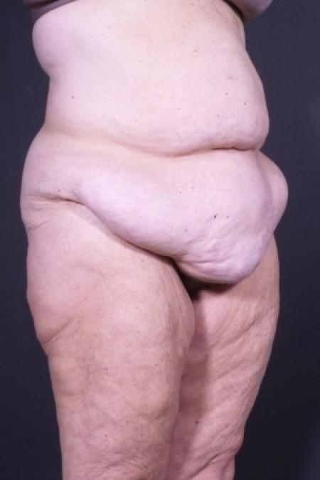 Before image 2 Case #85821 - Skin-only Abdominoplasty