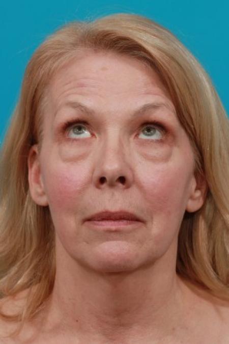 Before image 4 Case #83011 - Facial Rejuvenation