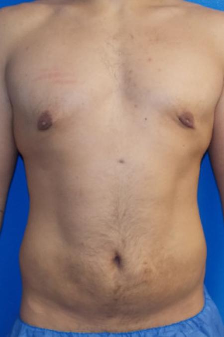 Before image 1 Case #88346 - Abdominal Etching/Liposuction