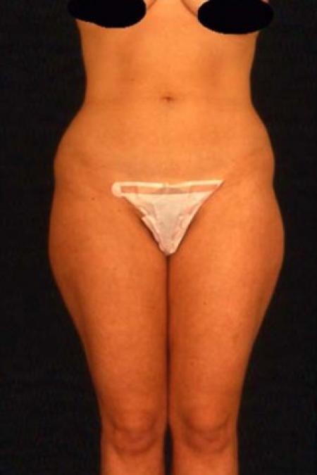 Before image 1 Case #81531 - Liposuction