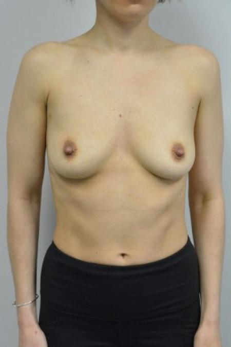 Before image 1 Case #88091 - 34-44 year woman treated with microtextured high profile cohesive silicone gel implants.  