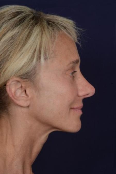 Before image 3 Case #87626 - Structural Fat Grafting