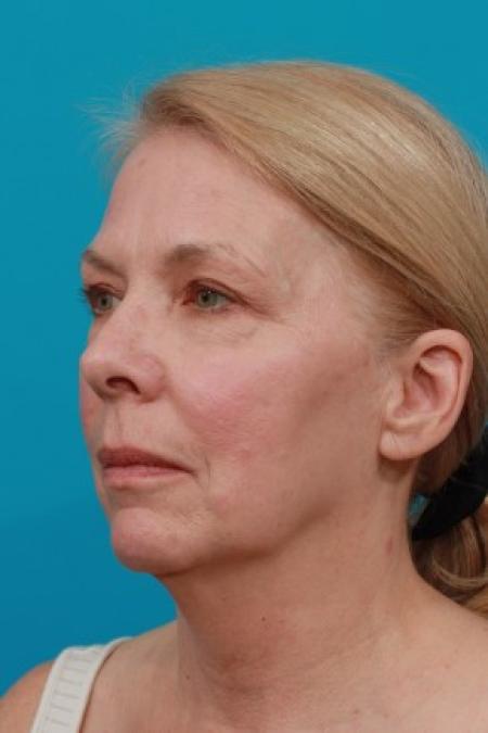Before image 2 Case #83011 - Facial Rejuvenation