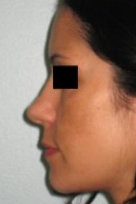 Before image 3 Case #85656 - Rhinoplasty 