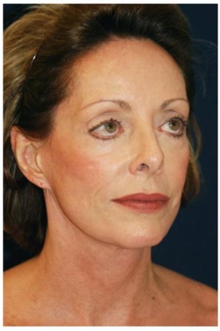 Before image 3 Case #82041 - Full Facial Rejuvenation