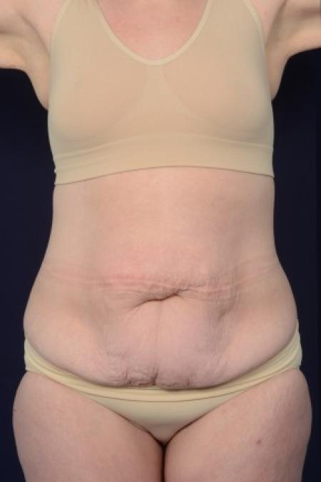 Before image 1 Case #87546 - Abdominoplasty