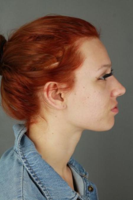 Before image 3 Case #87576 - Rhinoplasty