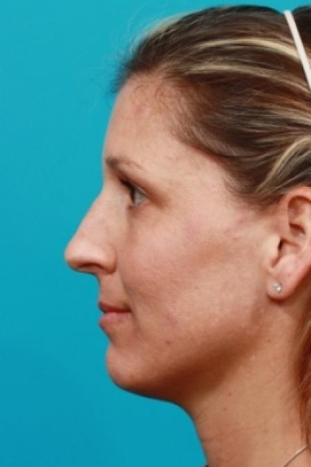 Before image 3 Case #80521 - Open Rhinoplasty