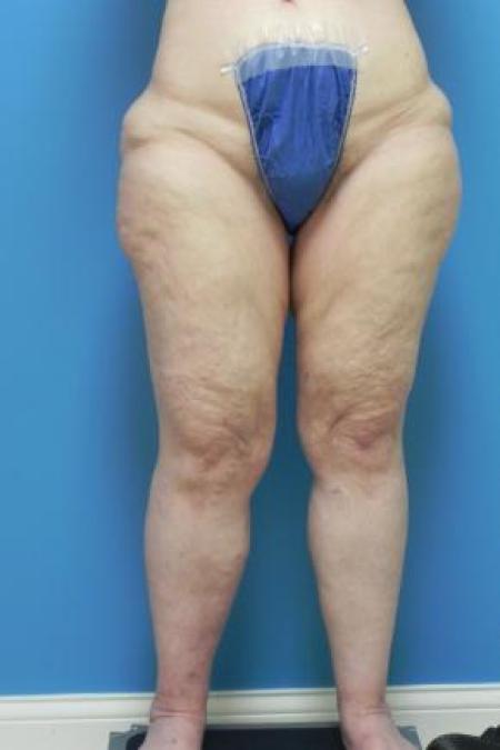 Before Case #80951 - Thigh Lift