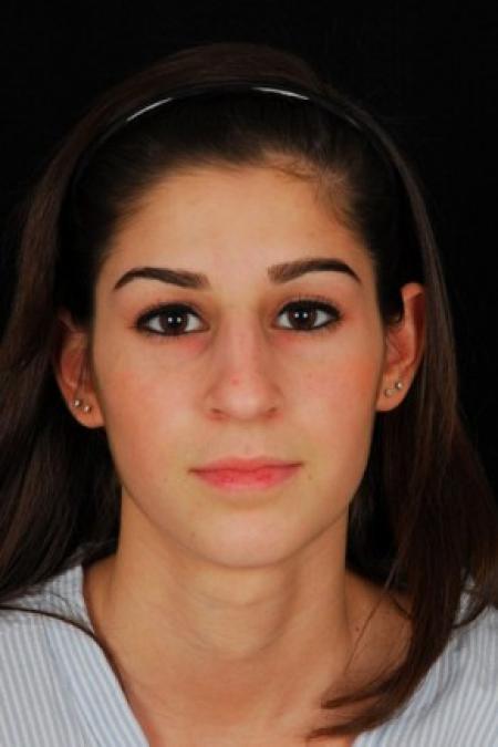 Before image 1 Case #81561 - Rhinoplasty