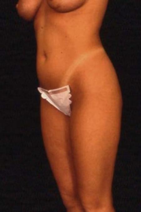Before image 1 Case #81521 - Liposuction