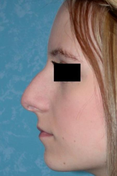 Before image 1 Case #81686 - Rhinoplasty