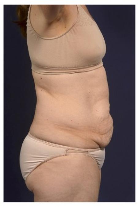 Before image 3 Case #84751 - Abdominoplasty