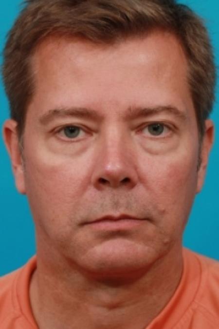 Before image 1 Case #78866 - Lower Blepharoplasty