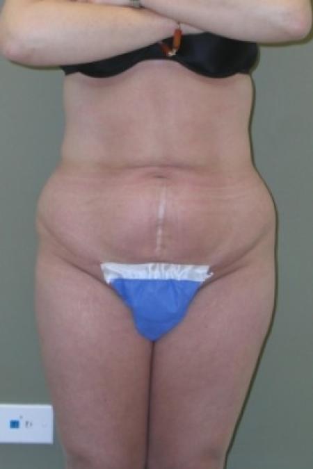 Before image 1 Case #81281 - Liposuction