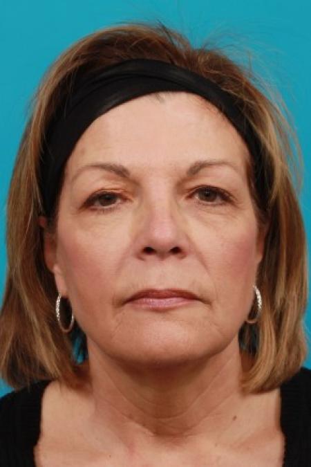 Before image 1 Case #85636 - Face Lift with Upper Blepharoplasty