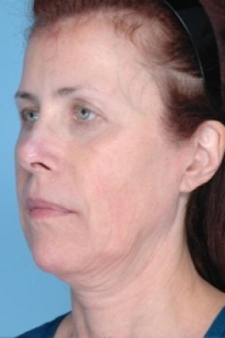 Before image 1 Case #79311 - Non-Surgical Focused Ultrasound