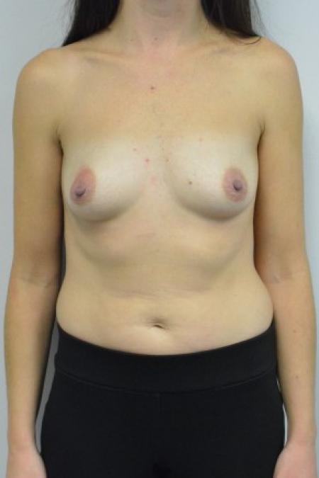Before image 1 Case #88086 - 34-44 year old woman treated with breast augmentation using Ideal Implants