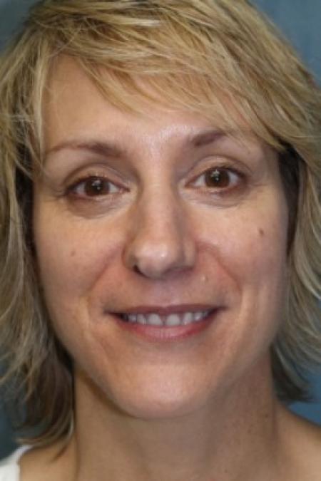 Before image 1 Case #81166 - Nose Reshaping
