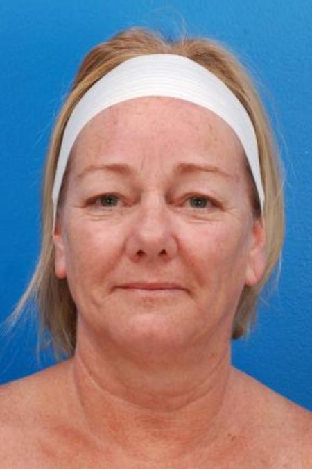 Before image 1 Case #85331 - 61 y/o woman after Laser Liposuction to the neck, skin tightening, eyelid surgery, & fat grafting to the face