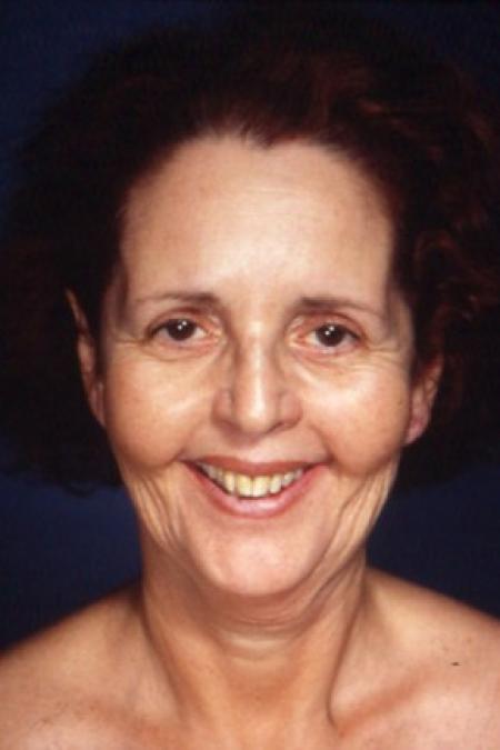 Before image 1 Case #81496 - Facelift