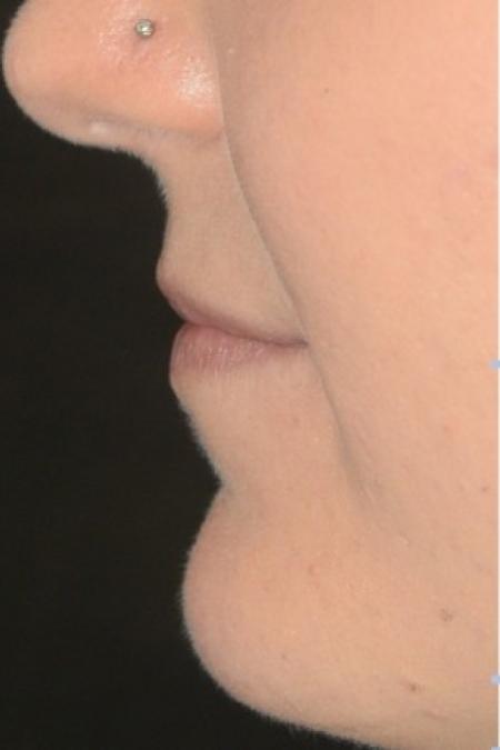Before image 2 Case #86336 - 26 year old woman treated with fillers