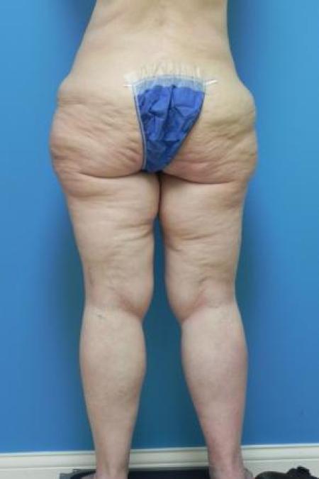 Before Case #80951 - Thigh Lift