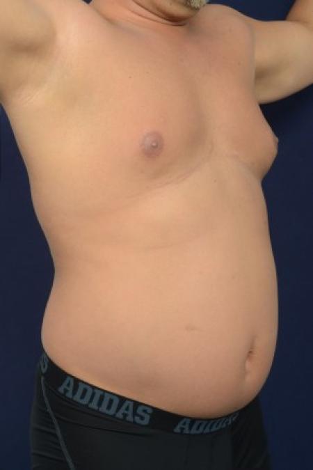 Before image 2 Case #87591 - Trunk Liposuction