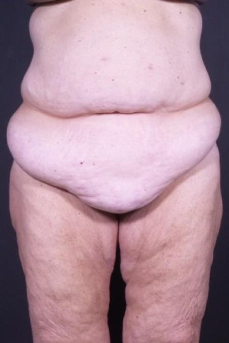 Before image 1 Case #85821 - Skin-only Abdominoplasty