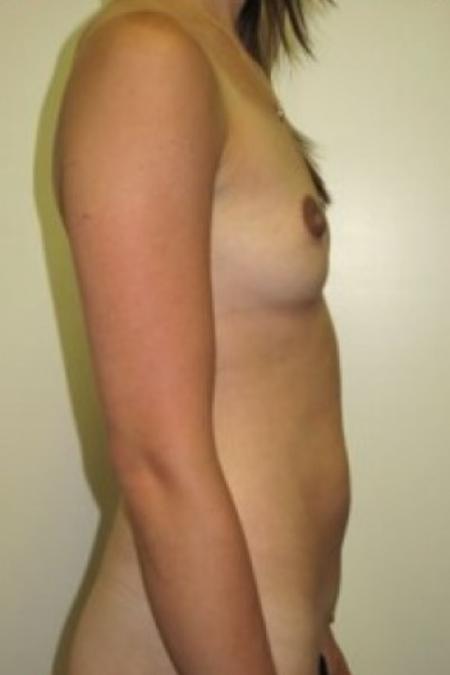 Before image 2 Case #85681 - Mommy Makeover 
