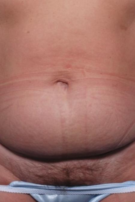 Before image 1 Case #81206 - Abdominoplasty and Liposuction