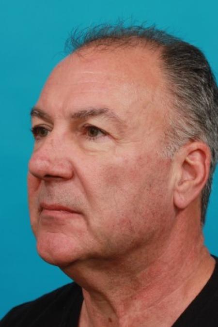 Before image 2 Case #86521 - Male Facial Rejuvenation
