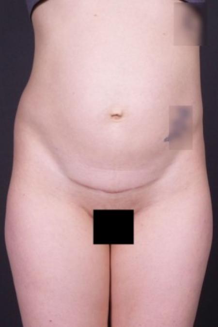 Before image 1 Case #85826 - Abdominoplasty